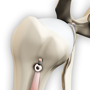 Biceps Tenodesis