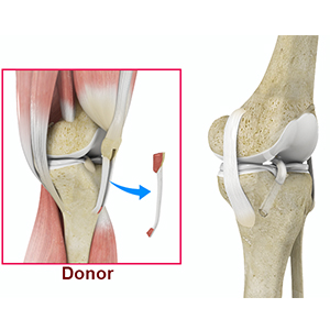 Bone-Patellar