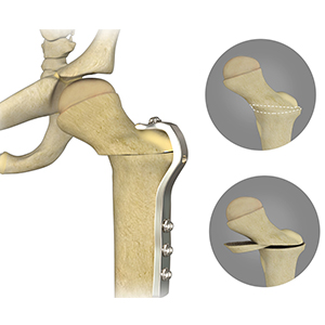 Derotational Femoral Osteotomy