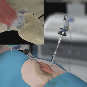 Gluteus Tendon Repair