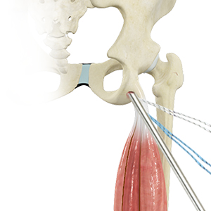 Hamstring Tendon Repair