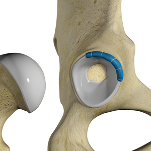 Labral Reconstruction