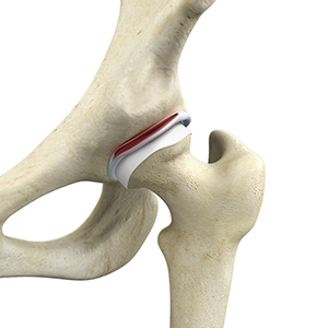 Hip Labral Repair
