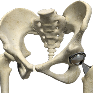 Hip Replacement