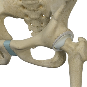 Labral Augmentation