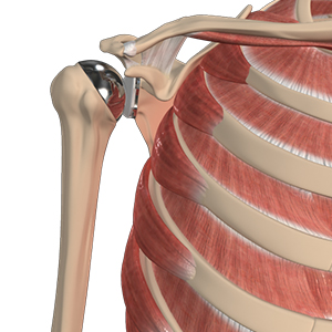 Shoulder Replacement
