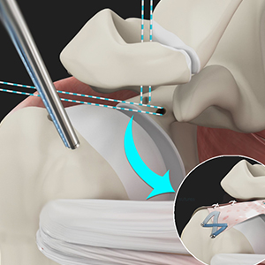 Superior Capsular Reconstruction (SCR)